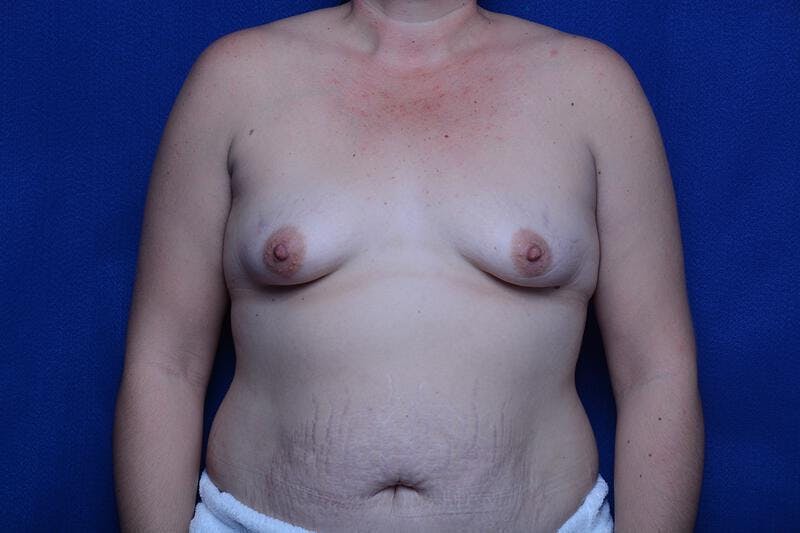 Tuberous Breast Before & After Gallery - Patient 863971 - Image 5
