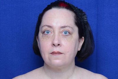 Lower Blepharoplasty Before & After Gallery - Patient 842697 - Image 2