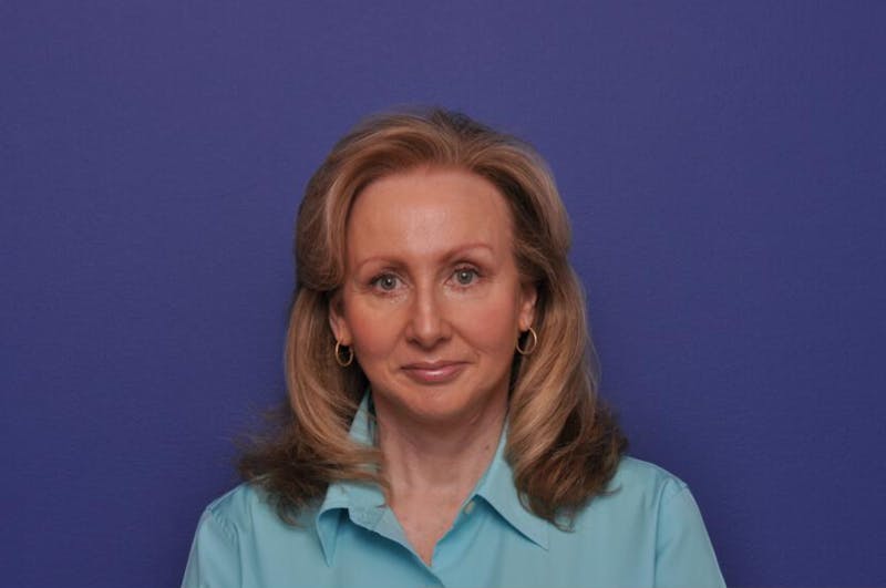 Lower Blepharoplasty Before & After Gallery - Patient 461964 - Image 2
