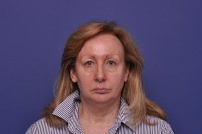 Facelift Before & After Gallery - Patient 399835 - Image 1