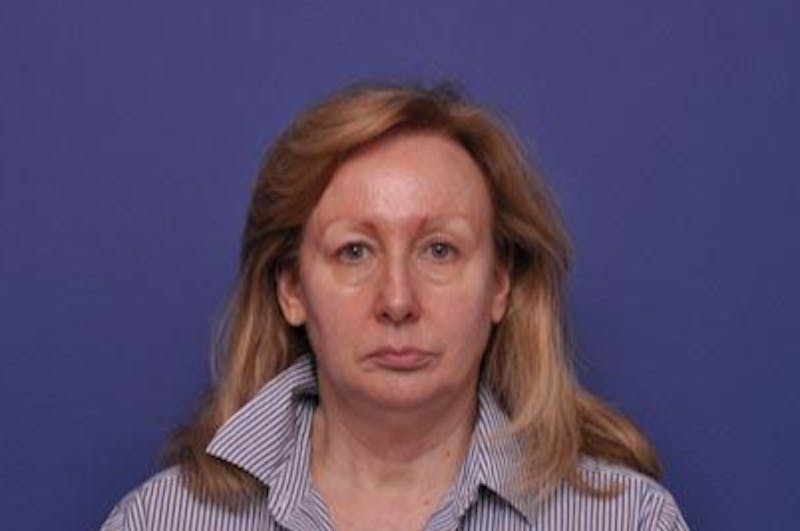 Facelift Before & After Gallery - Patient 399835 - Image 1