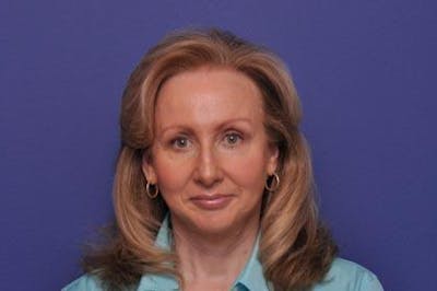 Facelift Before & After Gallery - Patient 399835 - Image 2
