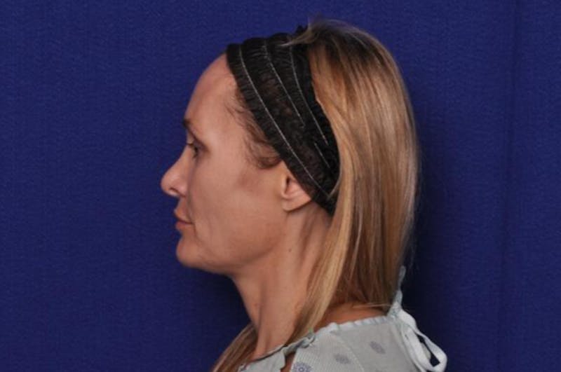 Upper Blepharoplasty Before & After Gallery - Patient 439261 - Image 3