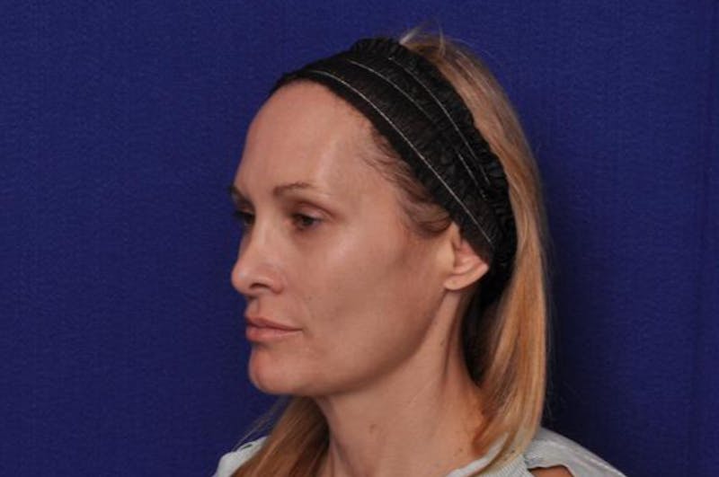 Upper Blepharoplasty Before & After Gallery - Patient 439261 - Image 5