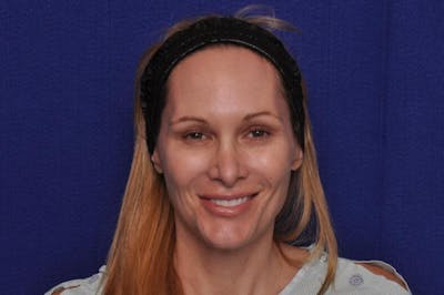 Upper Blepharoplasty Before & After Gallery - Patient 439261 - Image 1