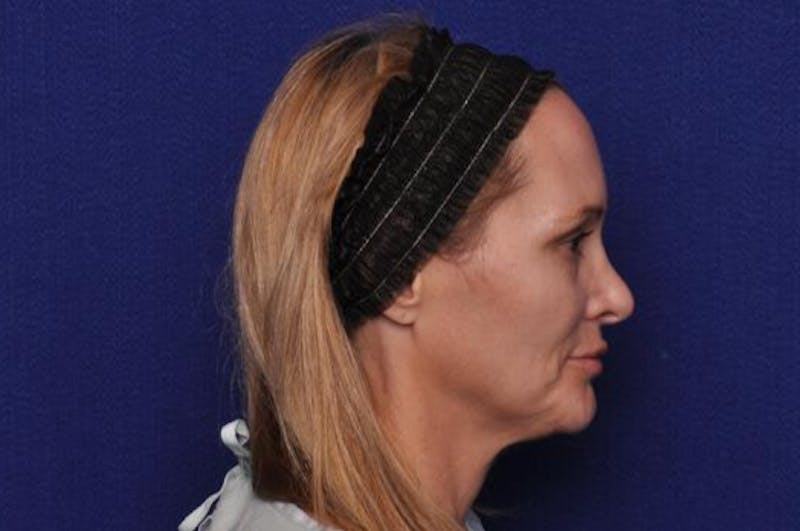 Upper Blepharoplasty Before & After Gallery - Patient 439261 - Image 9