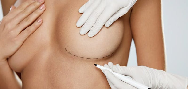 Breast augmentation diagram