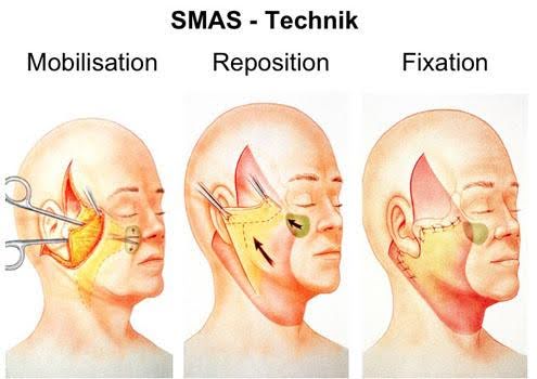facelift infographic