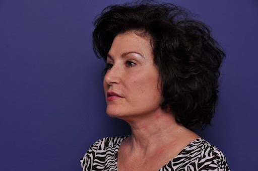 facelift patient