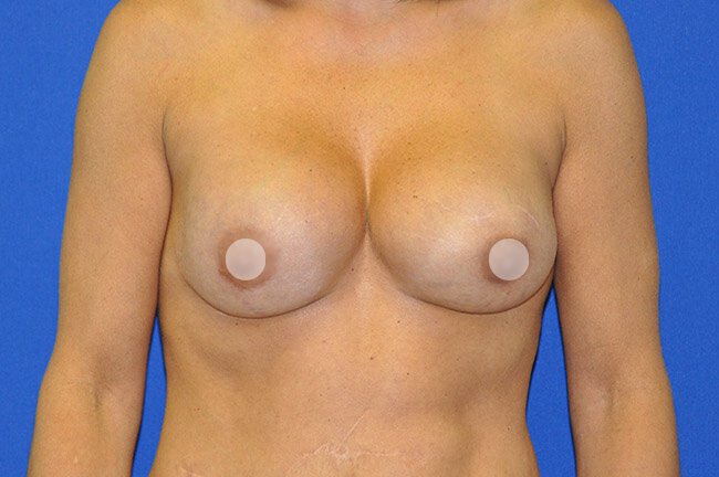 capsular contracture patient