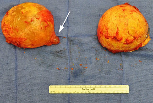 breast implants that had capsular contracture