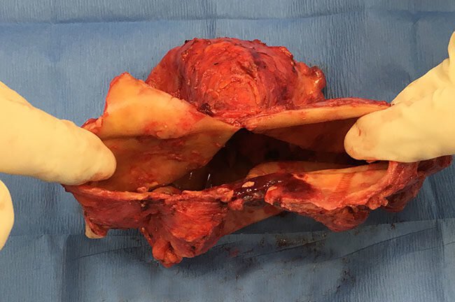 breast implant after capsulectomy