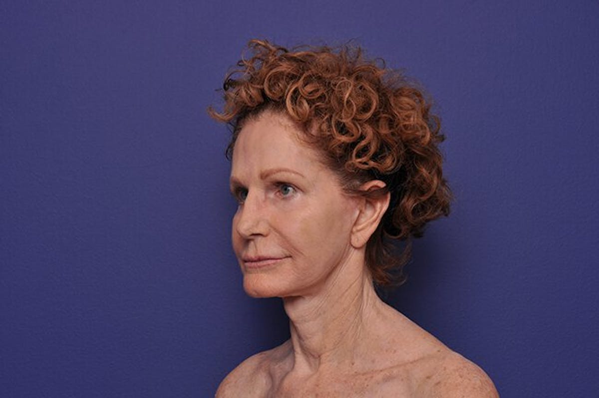 Services Offered By Ocean Drive Plastic Surgery Facelift Before & After Testimonial 5 | Ocean Drive