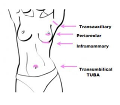 breast augmentation incision diagram