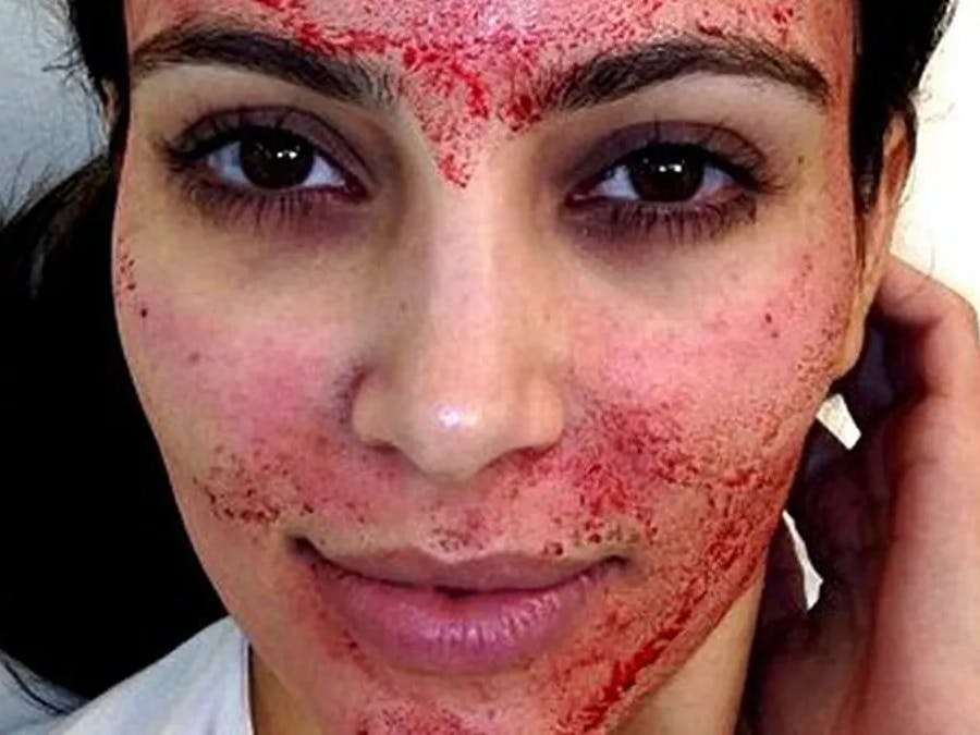 What is the Kim Kardashian-inspired ‘vampire facial’ as expert issues stark warning