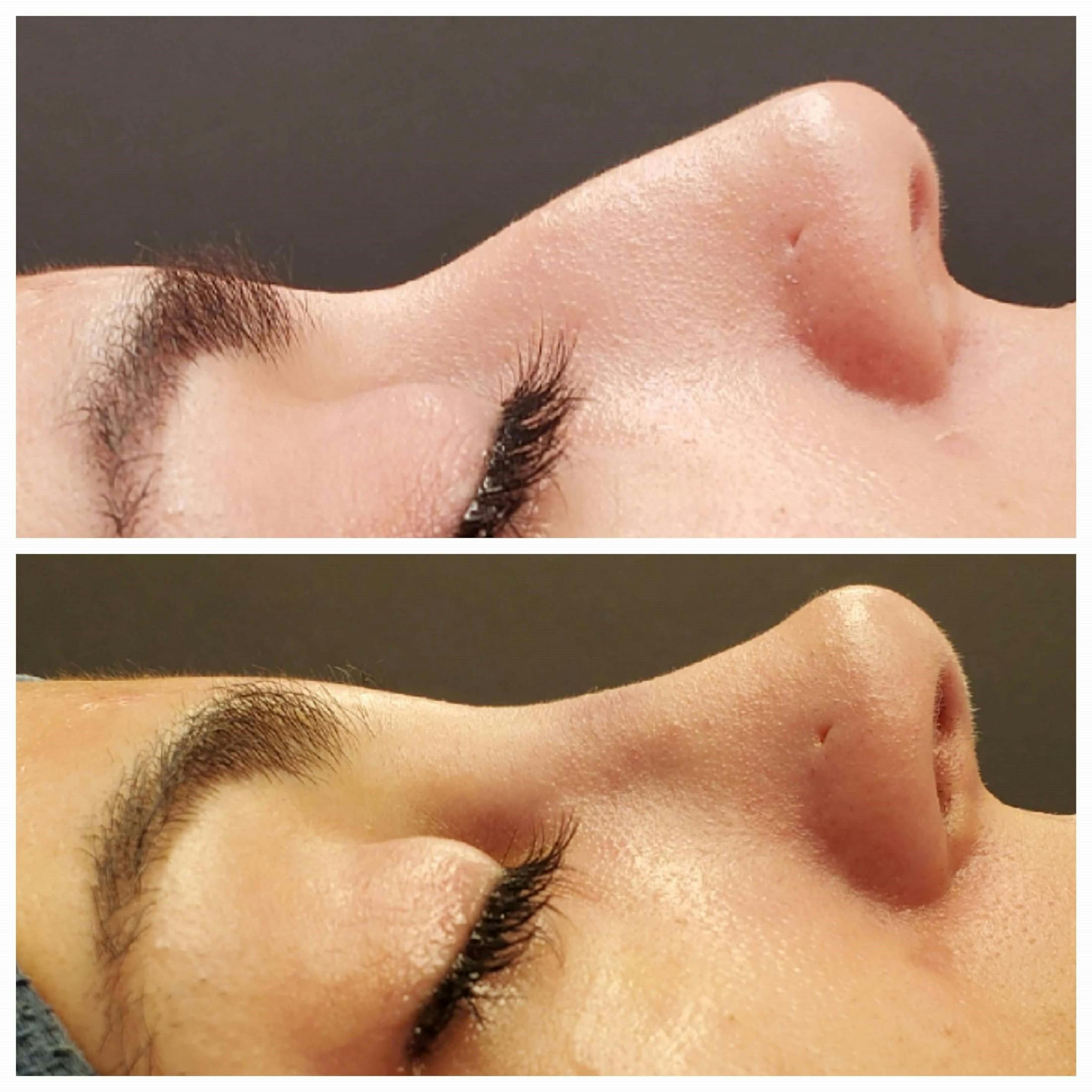 Rhinoplasty Before & After Gallery - Patient 567447 - Image 1