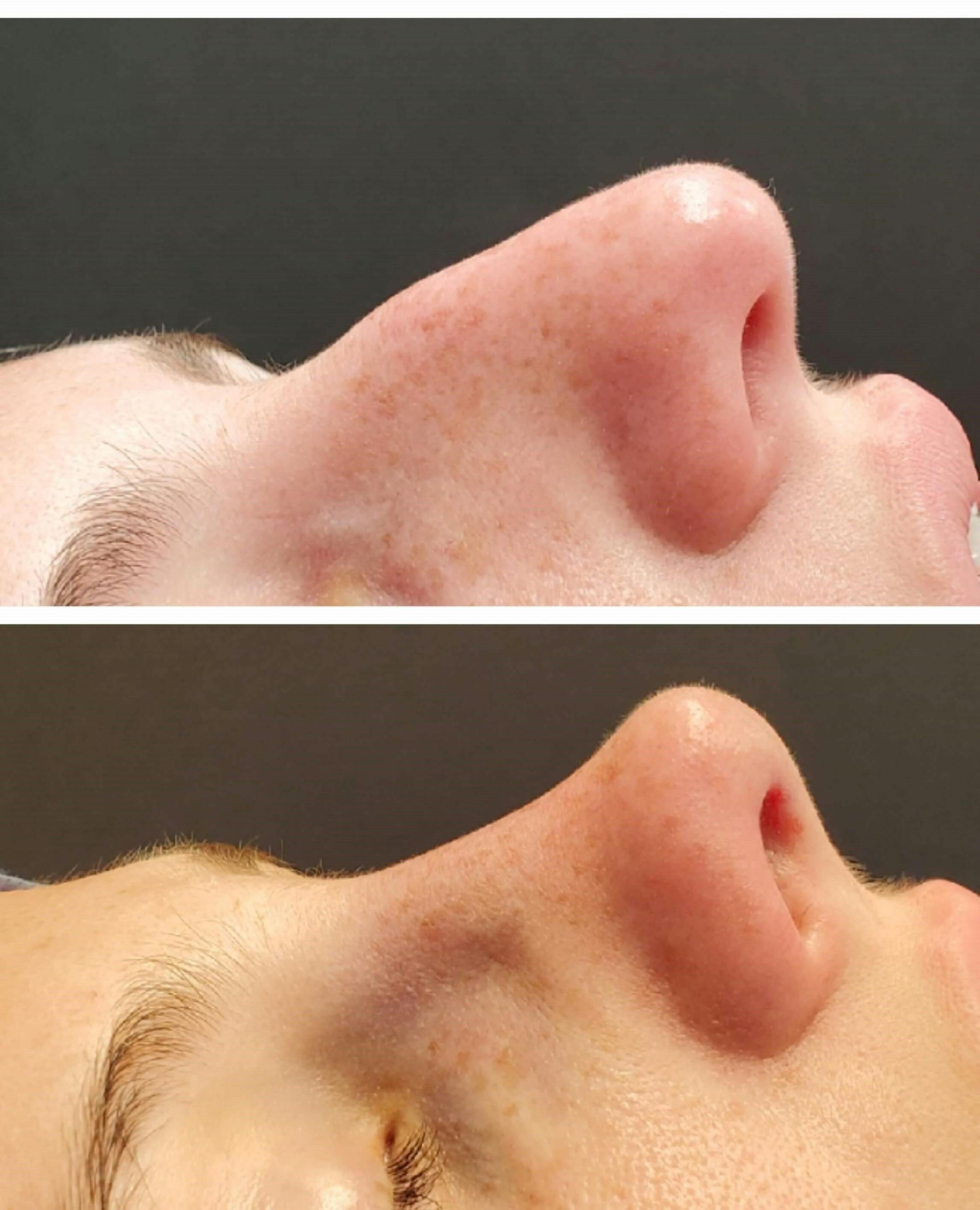 Rhinoplasty Before & After Gallery - Patient 567447 - Image 2