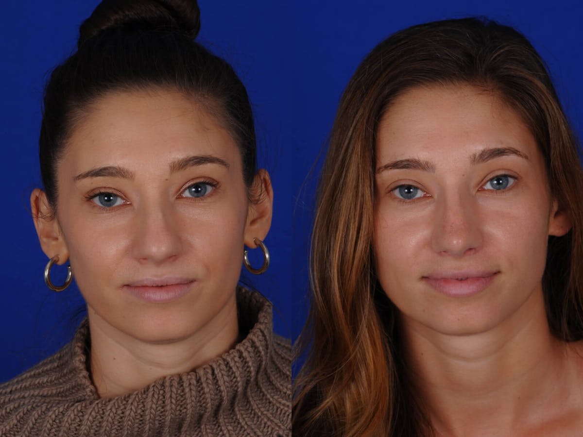 Rhinoplasty Before & After Gallery - Patient 369219 - Image 1