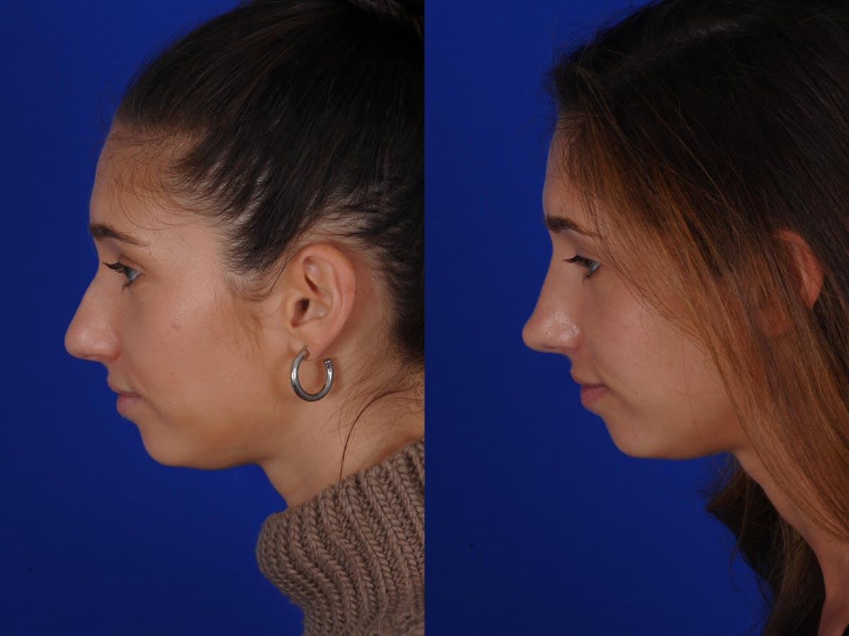 Rhinoplasty Before & After Gallery - Patient 369219 - Image 2