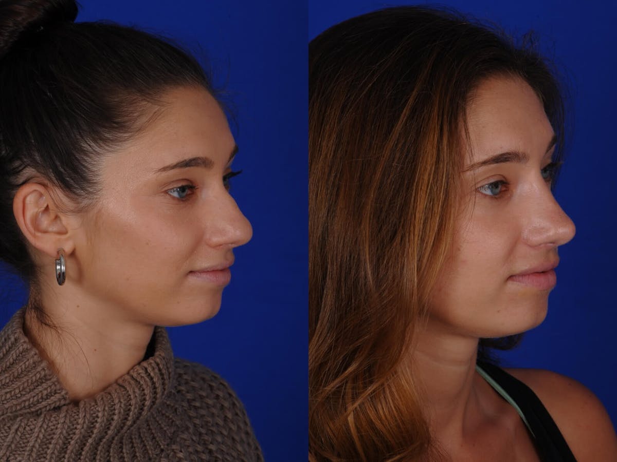 Rhinoplasty Before & After Gallery - Patient 369219 - Image 4