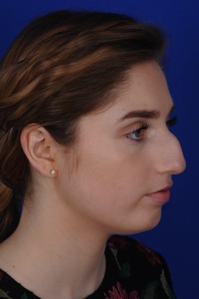 Rhinoplasty Before & After Gallery - Patient 277776 - Image 1