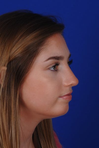 Rhinoplasty Before & After Gallery - Patient 277776 - Image 2