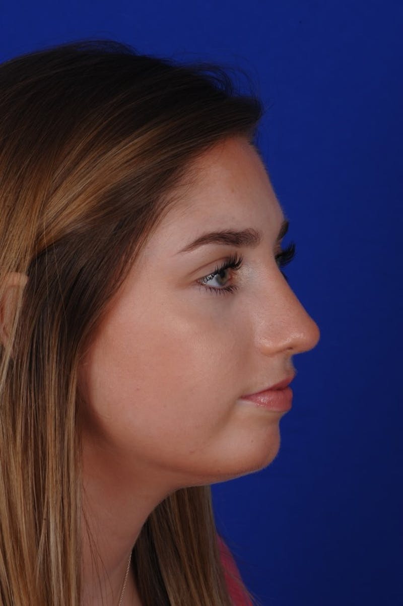 Rhinoplasty Before & After Gallery - Patient 277776 - Image 2