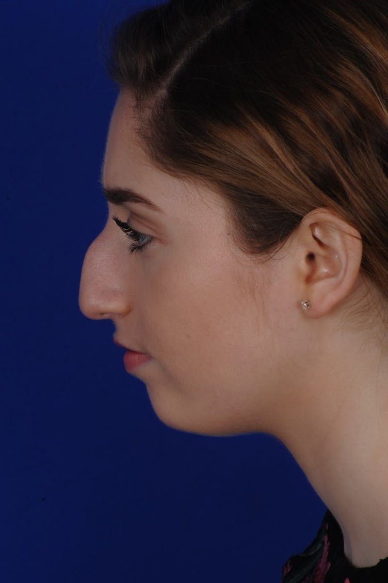 Rhinoplasty Before & After Gallery - Patient 277776 - Image 3
