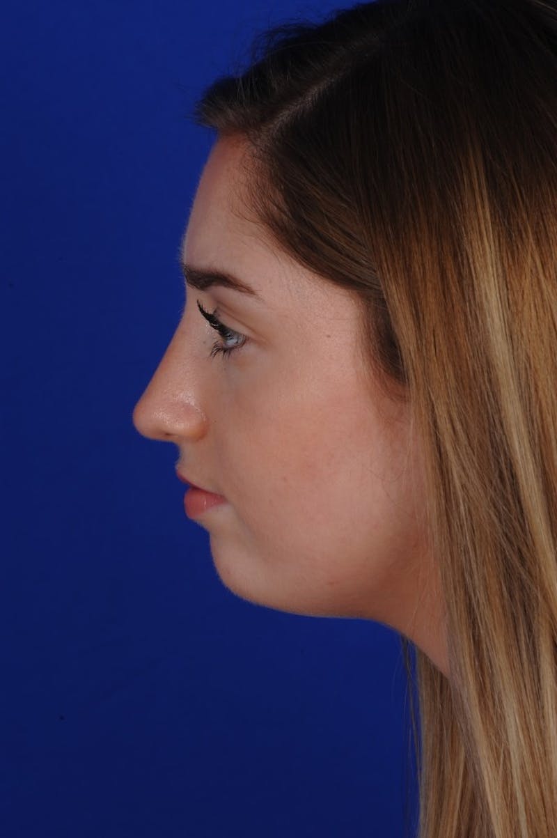Rhinoplasty Before & After Gallery - Patient 277776 - Image 4
