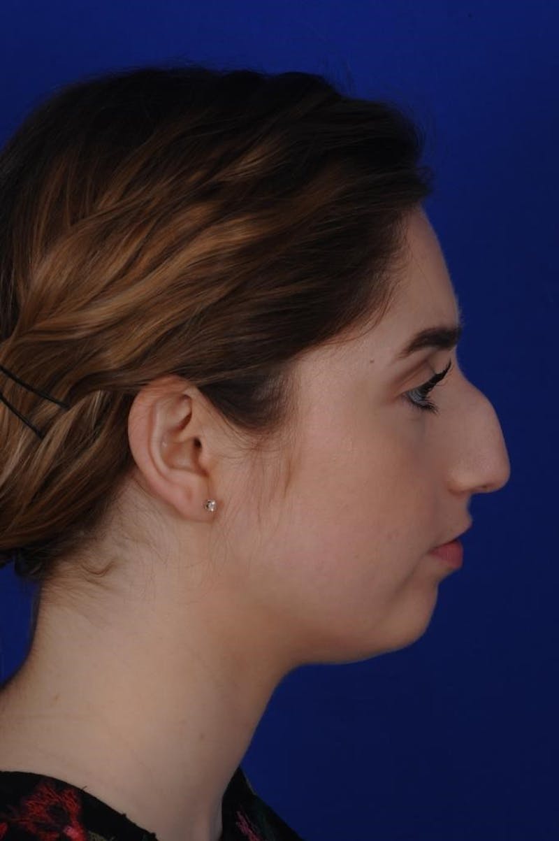 Rhinoplasty Before & After Gallery - Patient 277776 - Image 5