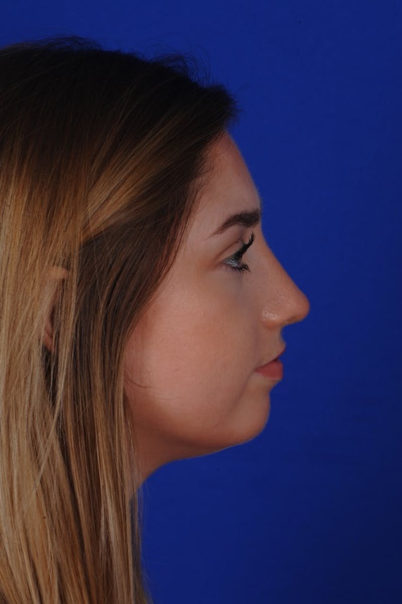 Rhinoplasty Before & After Gallery - Patient 277776 - Image 6