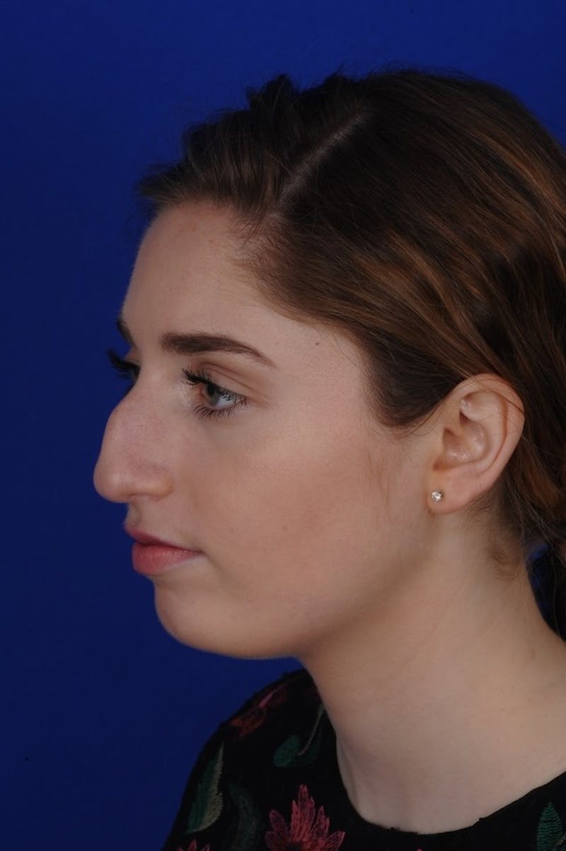 Rhinoplasty Before & After Gallery - Patient 277776 - Image 7