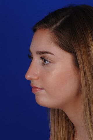 Rhinoplasty Before & After Gallery - Patient 277776 - Image 8