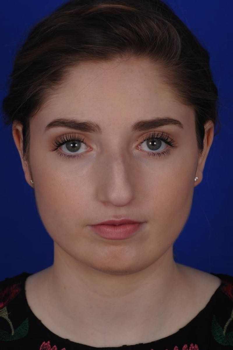 Rhinoplasty Before & After Gallery - Patient 277776 - Image 9
