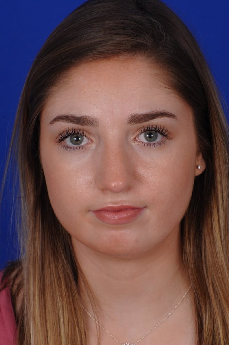 Rhinoplasty Before & After Gallery - Patient 277776 - Image 10