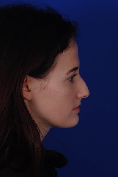 Rhinoplasty Before & After Gallery - Patient 116642 - Image 1