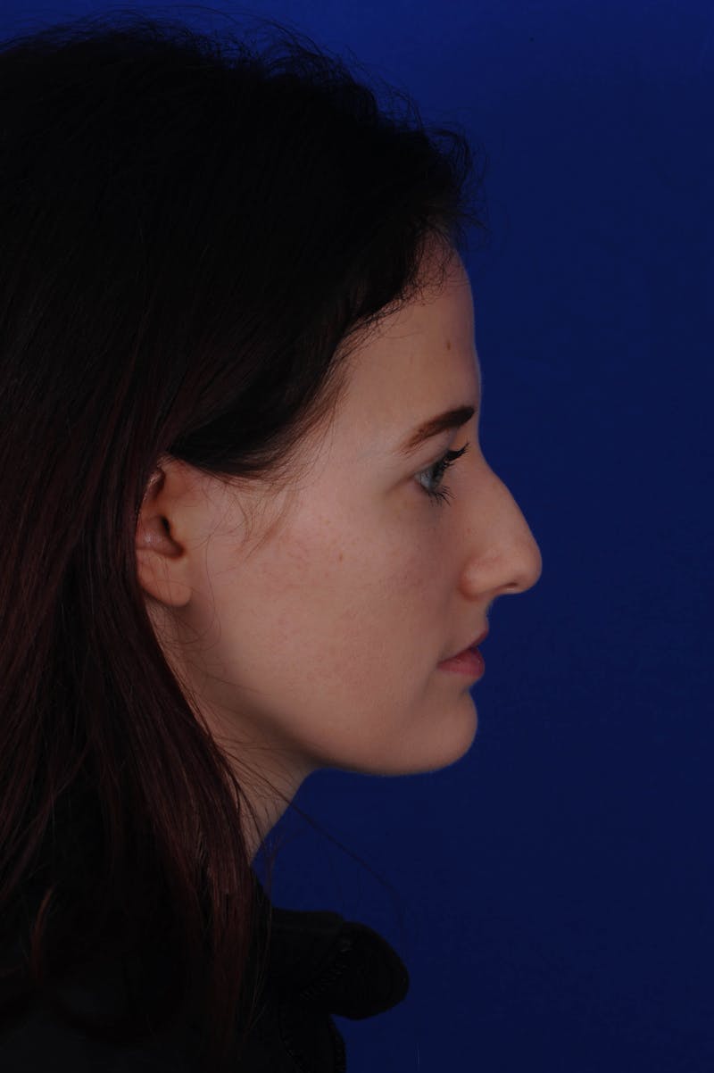 Rhinoplasty Before & After Gallery - Patient 116642 - Image 1