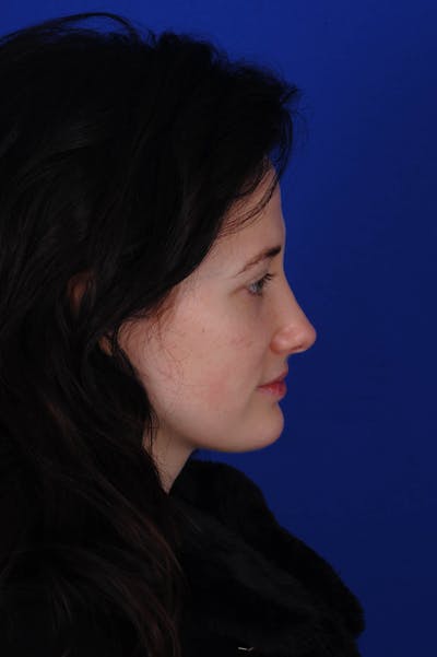 Rhinoplasty Before & After Gallery - Patient 116642 - Image 2
