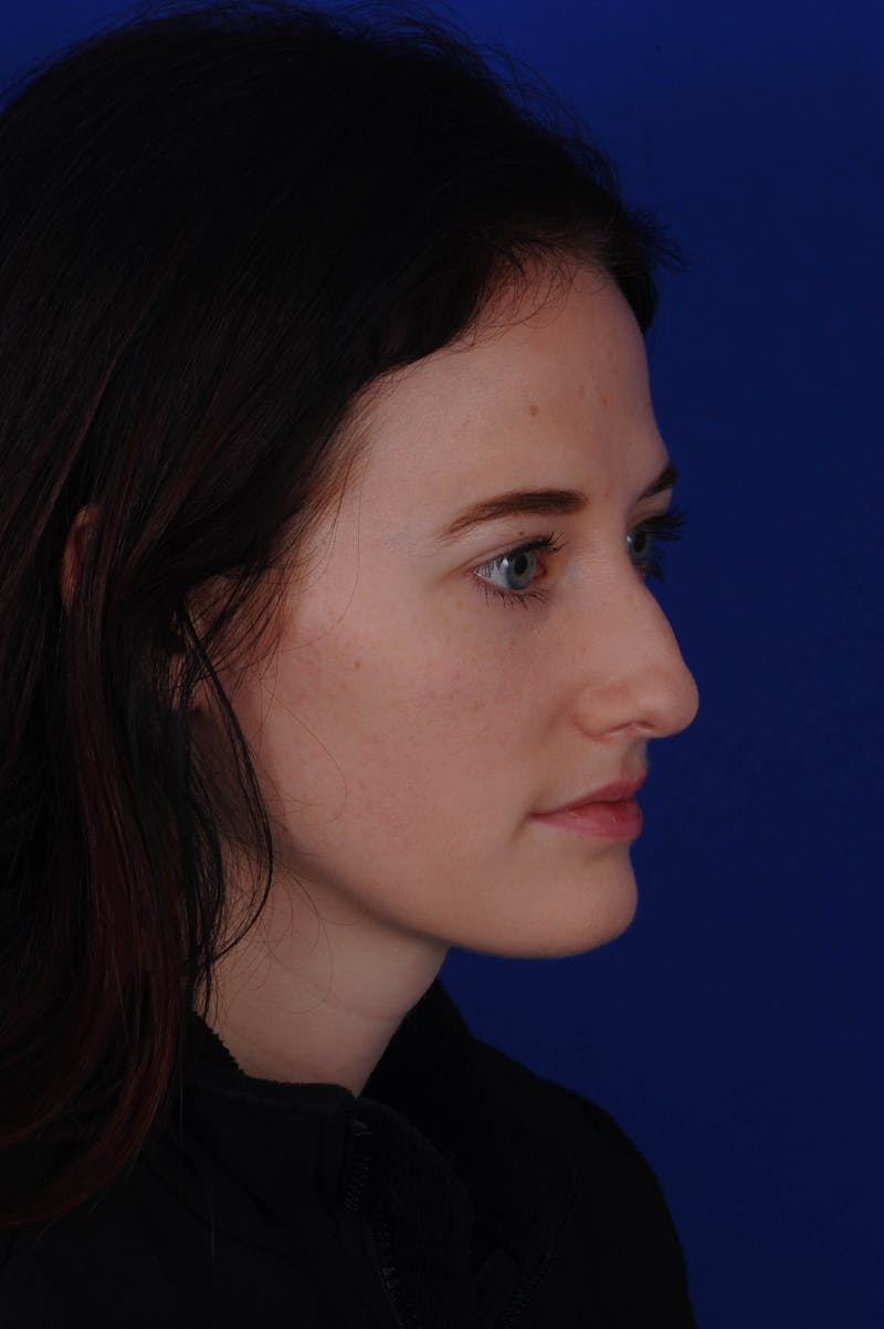 Rhinoplasty Before & After Gallery - Patient 116642 - Image 3
