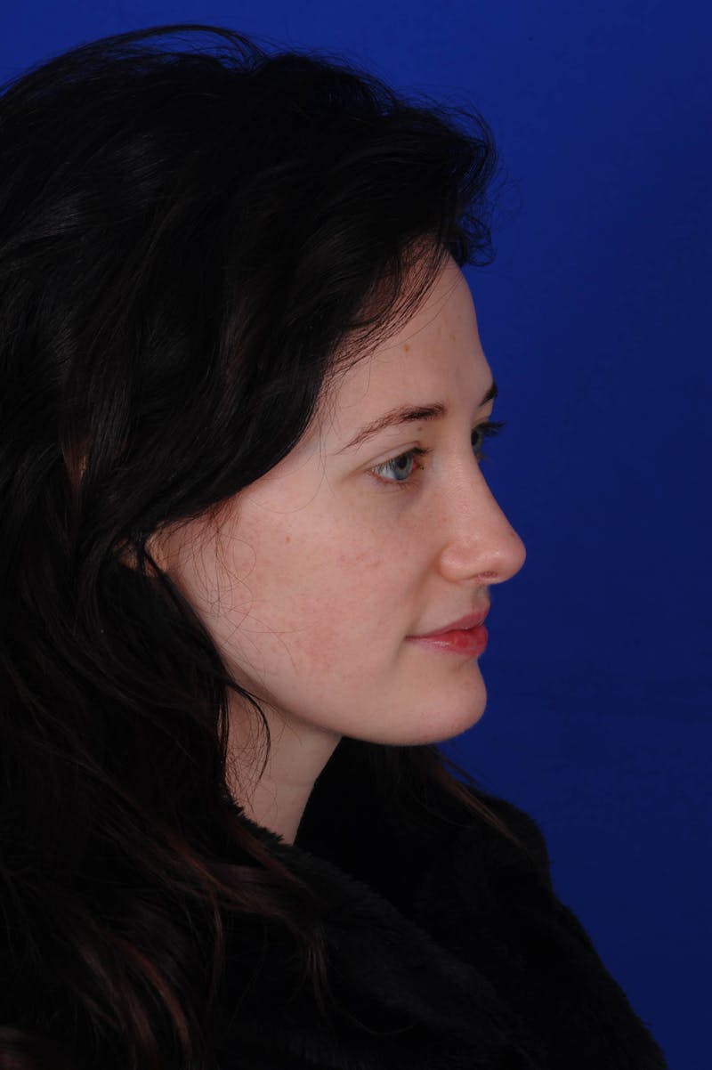 Rhinoplasty Before & After Gallery - Patient 116642 - Image 4