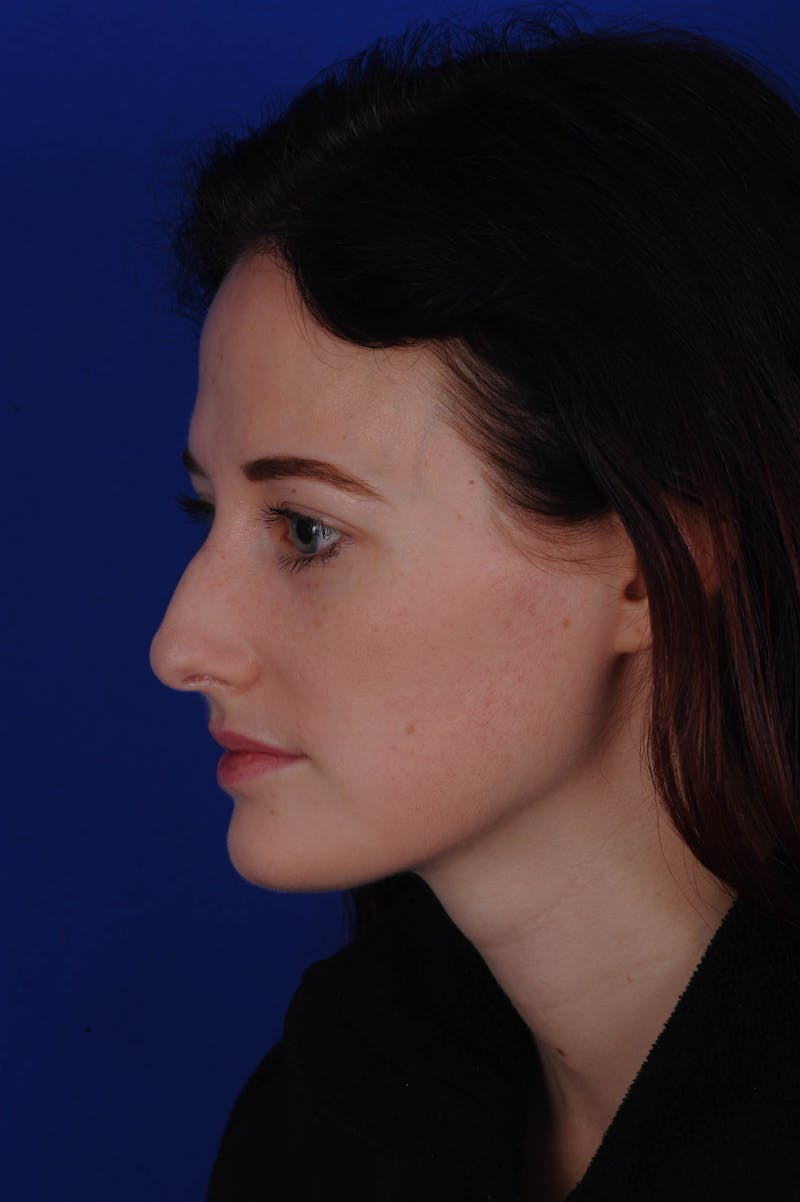 Rhinoplasty Before & After Gallery - Patient 116642 - Image 5