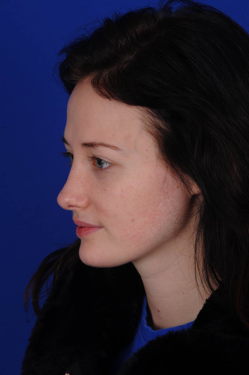 Rhinoplasty Before & After Gallery - Patient 116642 - Image 6