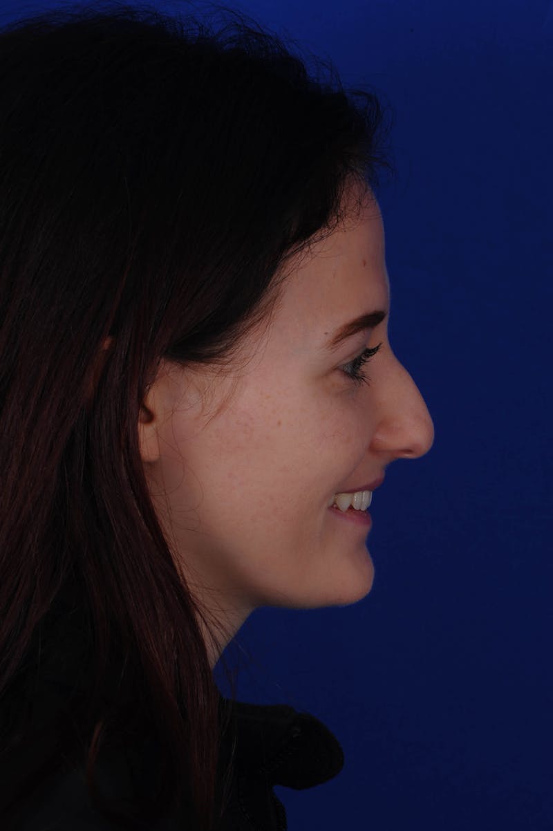 Rhinoplasty Before & After Gallery - Patient 116642 - Image 7