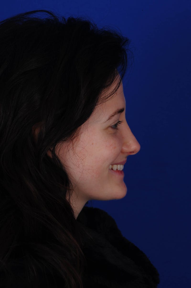 Rhinoplasty Before & After Gallery - Patient 116642 - Image 8