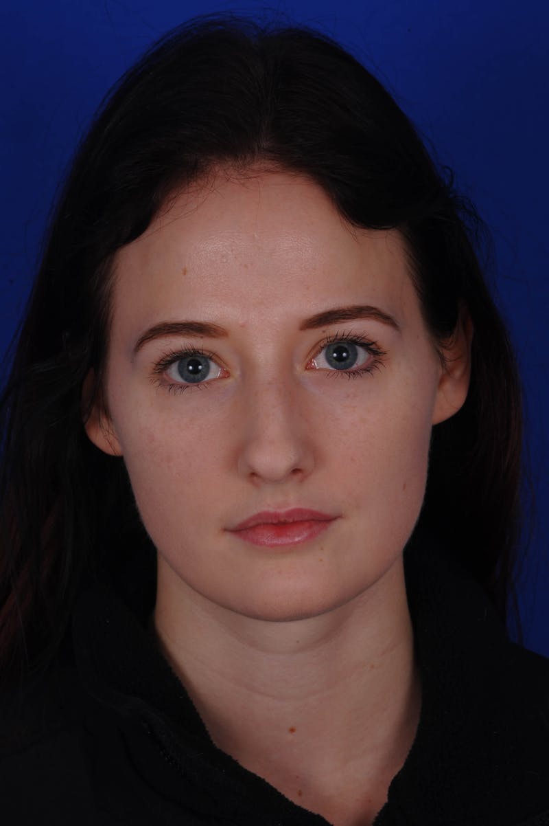 Rhinoplasty Before & After Gallery - Patient 116642 - Image 9
