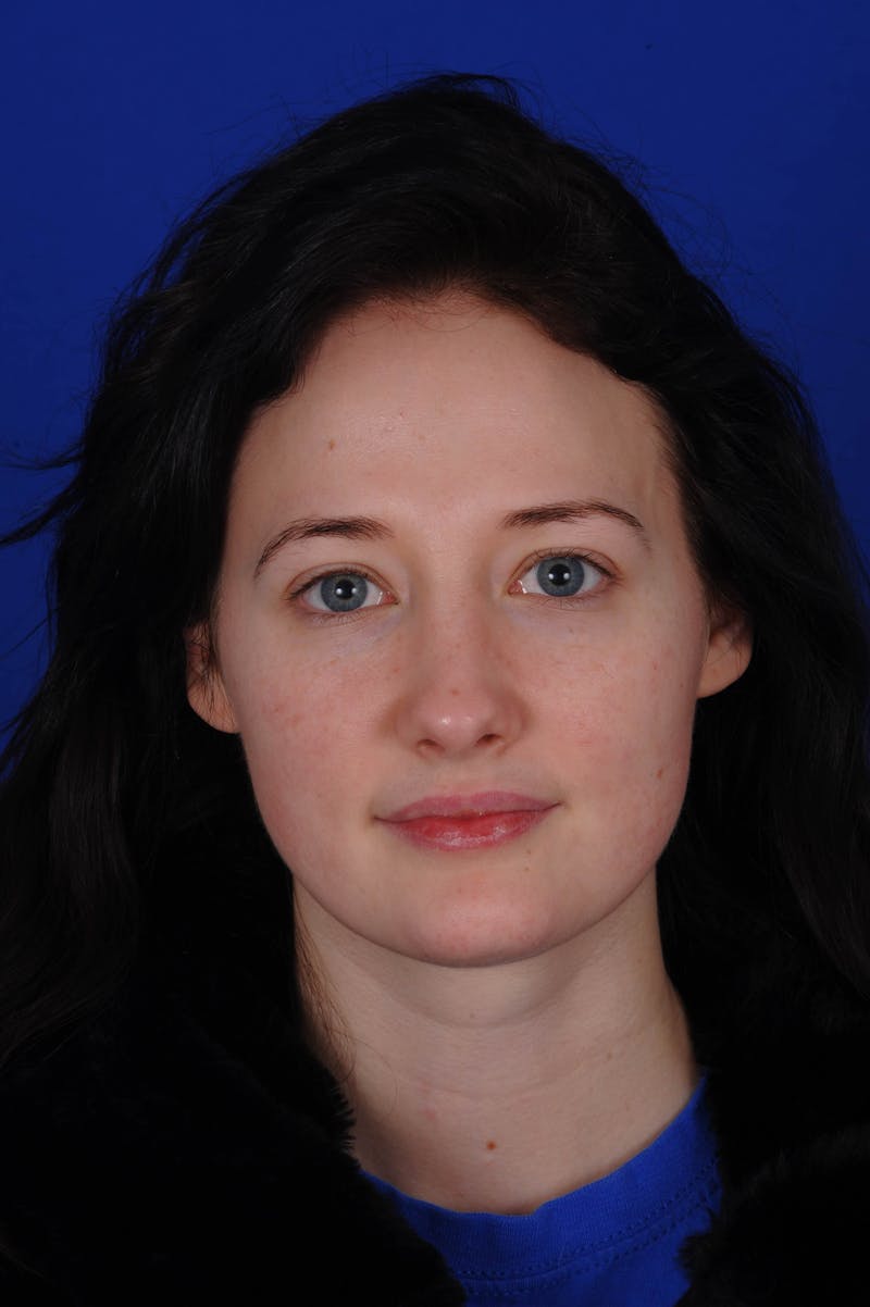 Rhinoplasty Before & After Gallery - Patient 116642 - Image 10