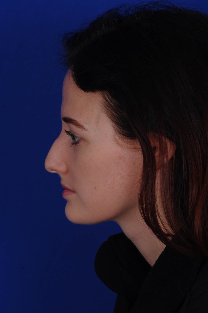 Rhinoplasty Before & After Gallery - Patient 116642 - Image 11