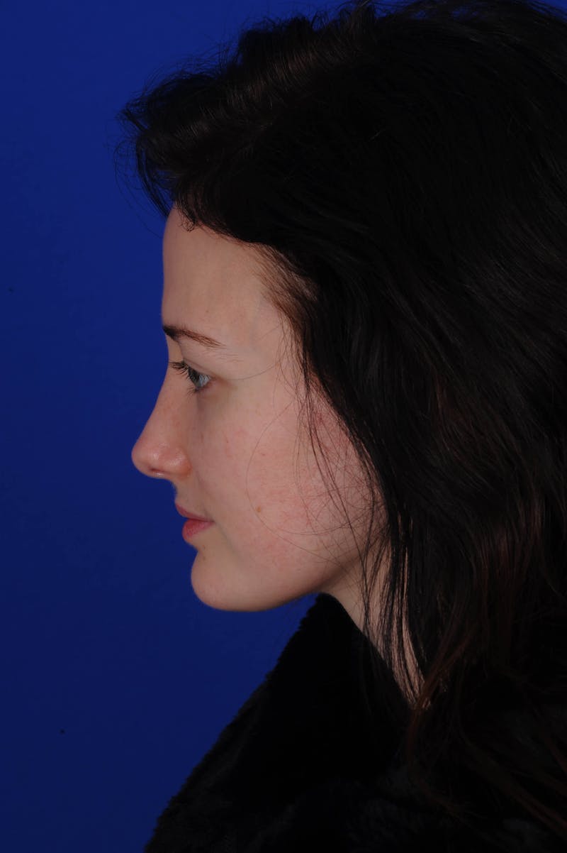 Rhinoplasty Before & After Gallery - Patient 116642 - Image 12