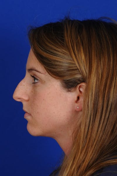 Rhinoplasty Before & After Gallery - Patient 406192 - Image 1