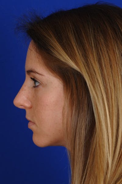 Rhinoplasty Before & After Gallery - Patient 406192 - Image 2